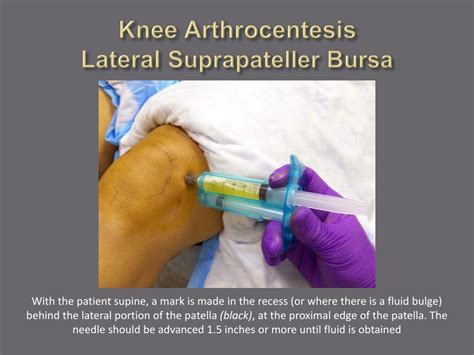 Ppt Arthrocentesis And Joint Injection For The Internist Powerpoint