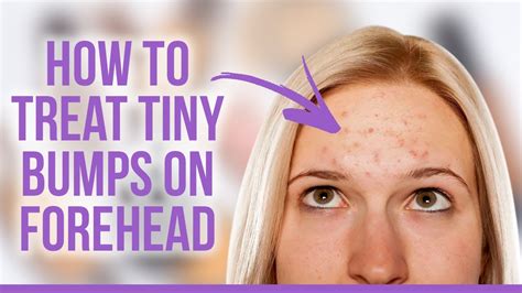 How To Treat Tiny Bumps On Forehead Youtube