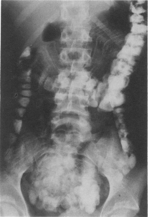 Plain Abdominal Radiograph Showing Contrast In The Large Bowel At 4 H