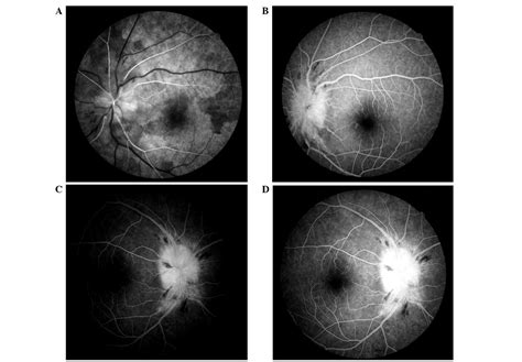 Cryptococcal Meningitis Initially Presenting With Eye Symptoms In An