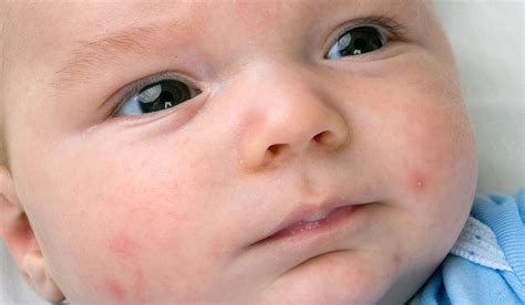 امراض الجلد عند الاطفال اشهر الامراض الجلدية للاطفال الحبيب للحبيب