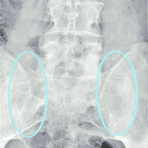 Pdf Differential Diagnosis And Management Of Ankylosing Spondylitis