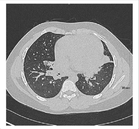 Computed Tomography Scan Of The Chest At The Level Of The Right Middle