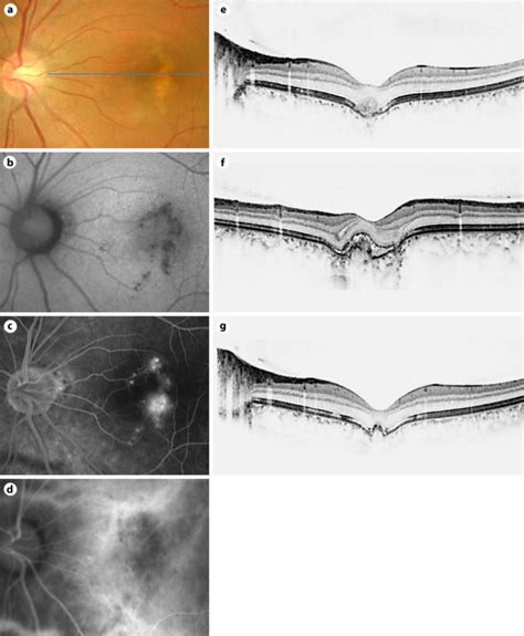 Findings In A 34 Year Old Woman With A Focal Choroidal Excavation