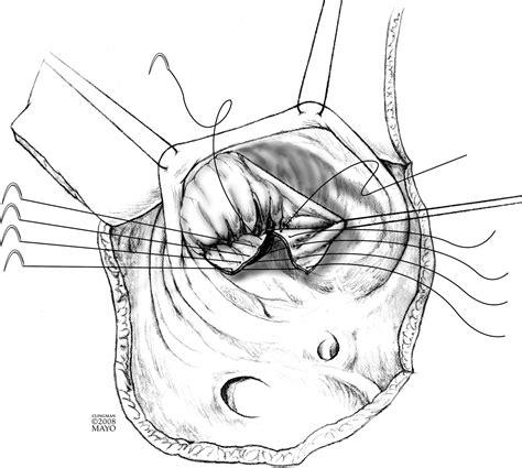 Cone Reconstruction Of The Tricuspid Valve For Ebsteins Anomaly