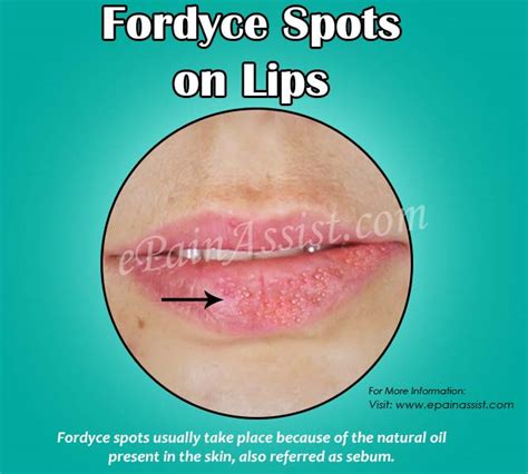 What Cause Fordyce Spots On The Lipstick
