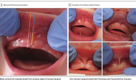 Pdf Anatomic Distribution Of The Morphologic Variation Of The Upper Lip Frenulum Among Healthy