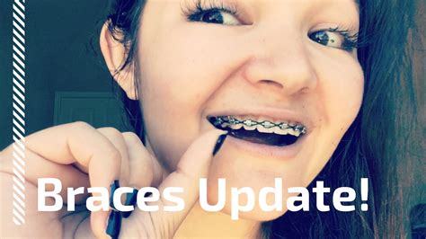 Adult Braces Update 2 Getting Them Off For The Military Youtube