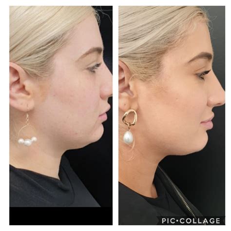 40 Off Double Chin Removal With Fat Dissolving Injections Only 396