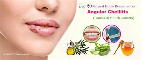Best Home Remedies For Angular Cheilitis Cracks In Mouth Corners Cracked Corners Of Mouth