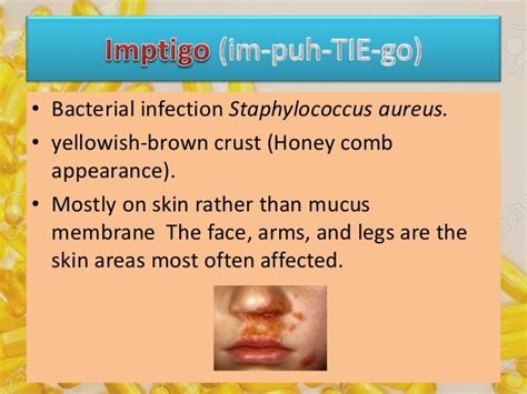 The Differences Between Imptigo And Herpes
