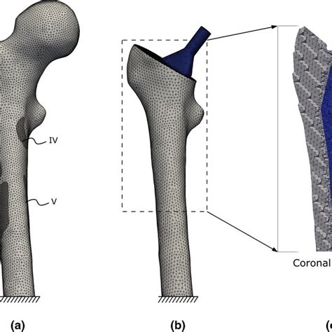 Fe Models Of The Intact And Implanted Femurs A Intact Femur B