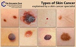 Types of Skin Cancer explained by a skin cancer specialist