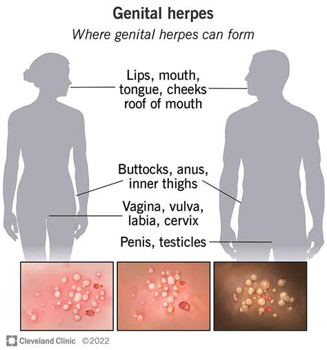 Herpes Simplex 2 Genital Causes Symptoms Diagnosis Treatment