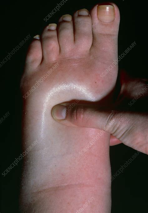 Swollen Foot Showing Pitting Oedema Stock Image M2300017
