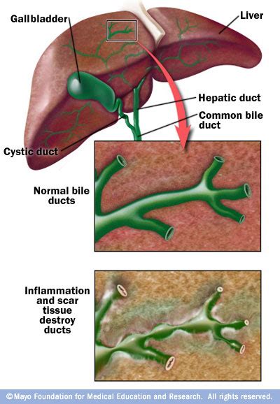 Primary Biliary Cirrhosis Disease Reference Guide