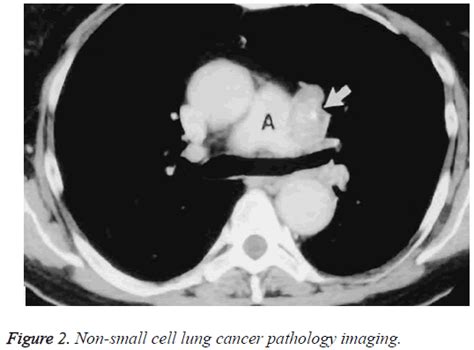 Ct Characteristics And Diagnostic Value Of Non Small Cell Lung Cancer