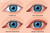 Stop the Spread of Pink Eye (Conjunctivitis) | Millennium Laser Eye Centers