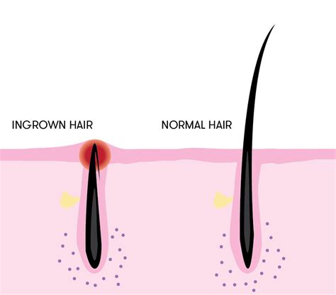 Ingrown Hair What It Looks Like Causes Treatment Off