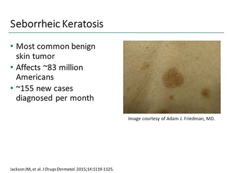 Why Seborrheic Keratosis Should Be On Your Radar Transcript