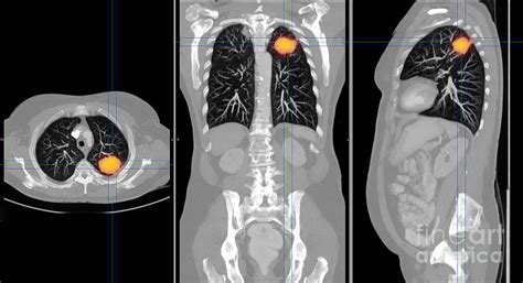 Lung Cancer Ct Scan Photograph By Scott Camazine Pixels