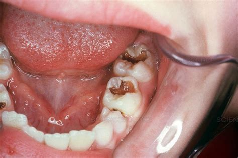 What Is Dental Caries