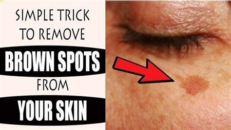 Simple Trick To Remove Brown Spots From Your Skindark Spots On Face