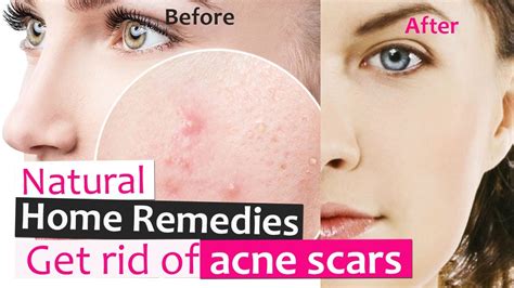 how to get rid of acne and scars overnight natural home remedies that really works youtube