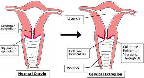 Cervical Ectropion Causes Symptoms And Cervical Ectropion Treatment