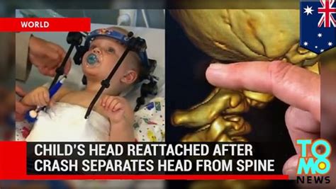 Head Reattached After Decapitation Toddlers Skull Fused To Spine
