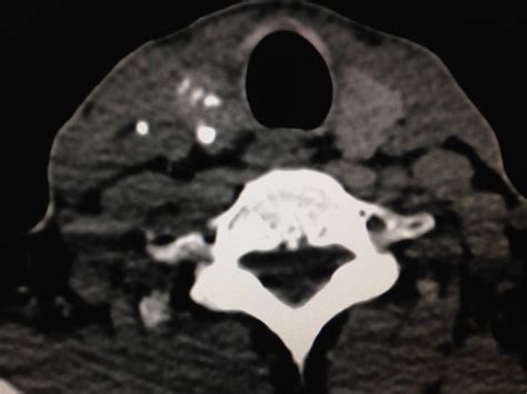 Vietnamese Medic Ultrasound Case 460 Calcified Thyroid Tumor Dr