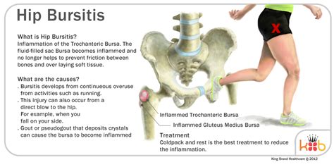 Hip Bursitis Diagram