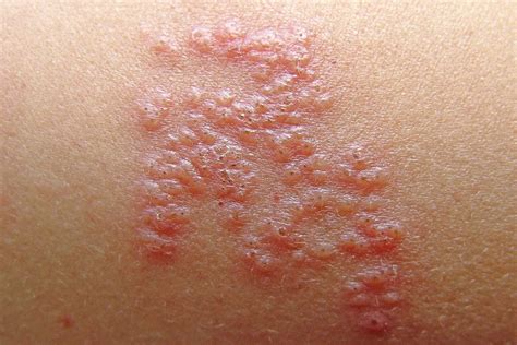 Shingles Treatment Medication And Prevention Pain Relief Antiviral