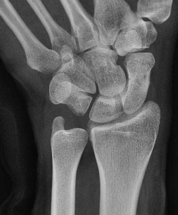 Scaphoid PA Ulnar Deviation View Radiology Reference Article Radiopaedia Org