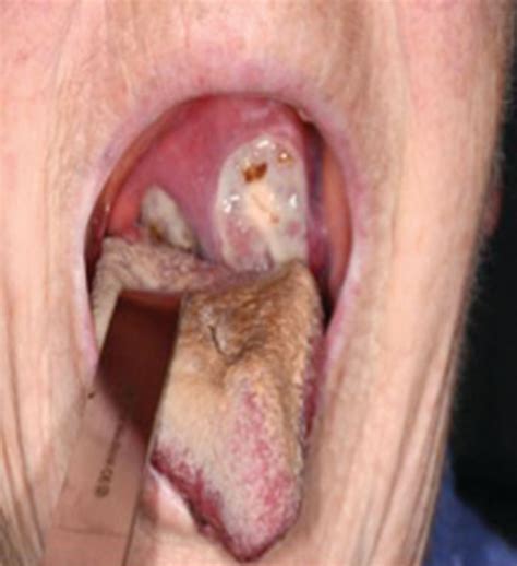 What Does Throat Cancer Look Like Nhs What Does Mouth Cancer Look
