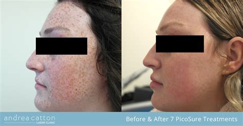 Removing Freckles With Co2 Laser Treatment Benefits Risks And Tips For Success Justinboey