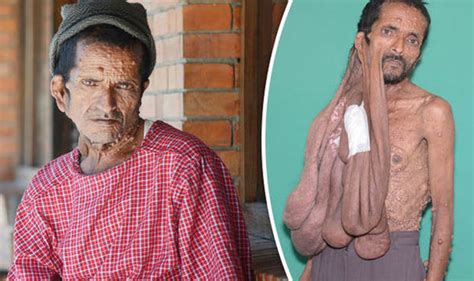 Nepalese Man Has Huge 11kg Tumour Removed From His Face