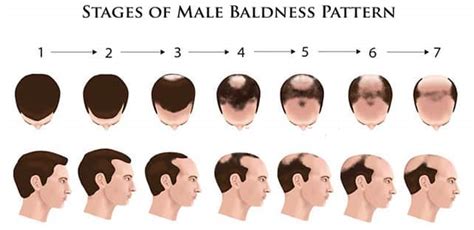 Causes Of Male Pattern Baldness And Prevention Hair Sure