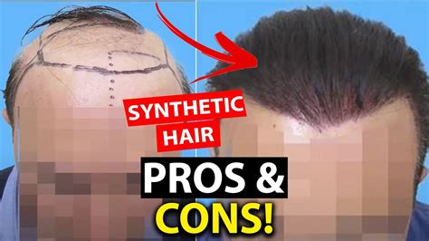Synthetic Hair Implants Pros And Cons Of Artificial Hair Before And