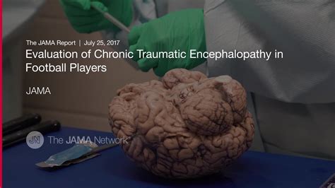 Evaluation Of Chronic Traumatic Encephalopathy In Football Players YouTube