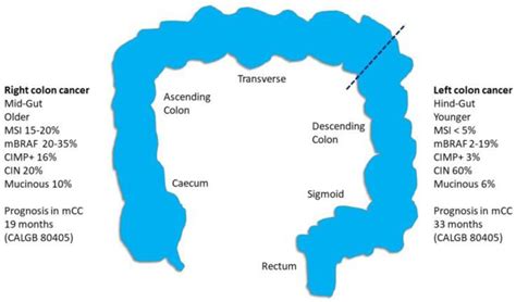 Right Versus Left Sided Colon Cancer Is It Time To Consider These As Different Diseases