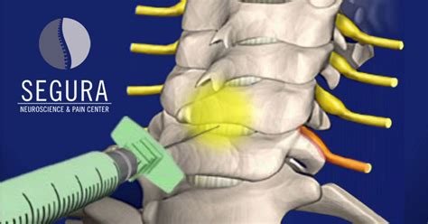 Cervical Epidural Steroid Injections Segura Pain Center