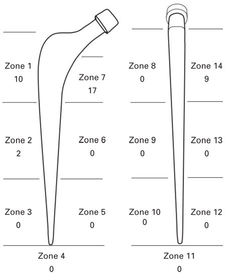 Diagram Of Osteolysis In The Zones Of Gruen Et Al 13 Download