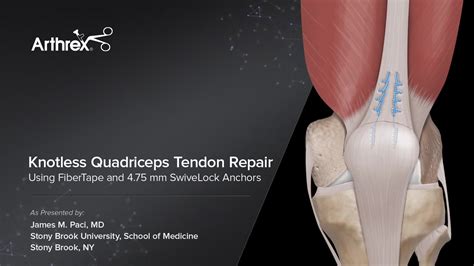 Arthrex Knotless Quadriceps Tendon Repair Using Fibertape® And 475 Mm Swivelock® Anchors