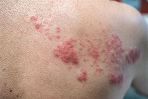 Shingles And Hiv What Is The Link