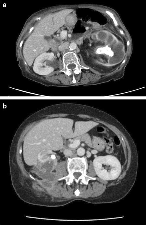 Axial Ct Scan Images Demonstrate Obstructing Left Pelvic Staghorn Stone