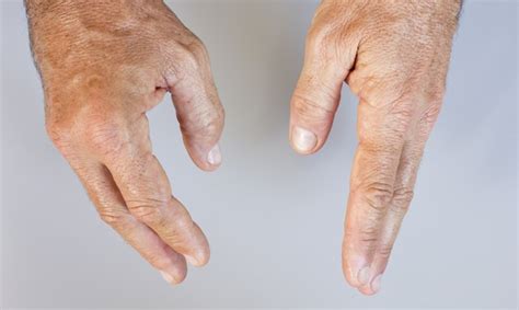 Early Signs Of Arthritis In Fingers Livestrongcom