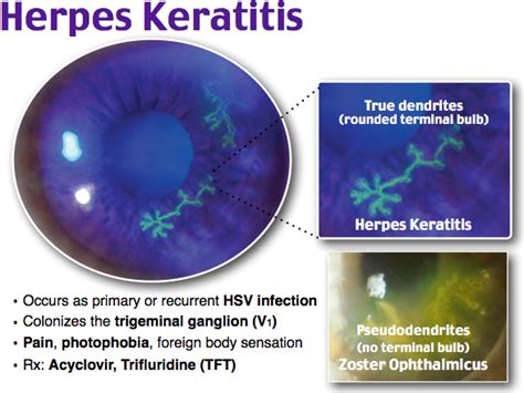 Herpes zoster ophthalmicus (hzo), commonly known as shingles, is a viral disease characterized by a unilateral painful skin rash in one or more dermatome distributions of the fifth cranial nerve (trigeminal nerve). Pin on ophthalmology