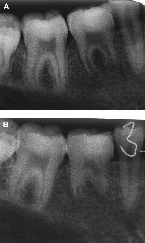 Immediate Autotransplantation Of Mandibular Third Molar In China Oral