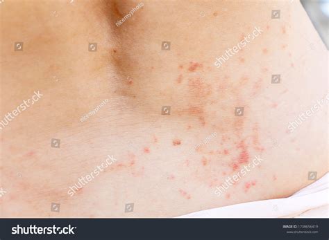 Skin Disease Prickly Heat Rash Miliaria Stock Photo 1738656419